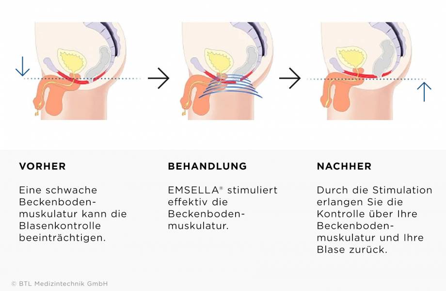 Drei Illustrationen erklären im Querschnitt die Anhebung des Beckenbodens beim Mann