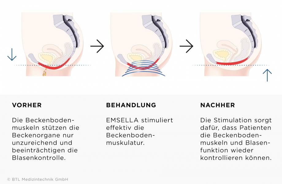 Drei Grafiken erklären im Querschnitt die Wirkweise von Emsella